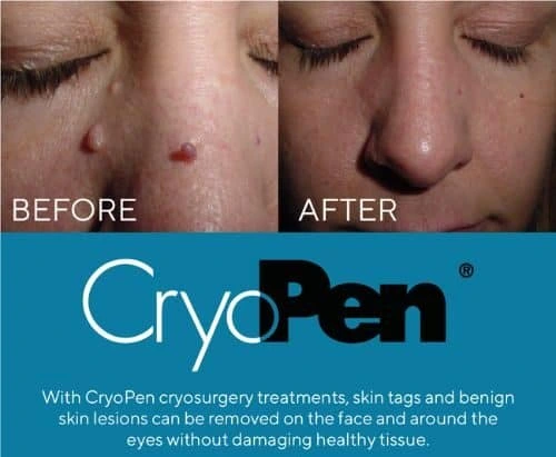 image of angiofibroma removal Burbage using Lipo Sculpt cryopen!